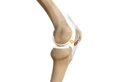Patellar Tendinitis (Jumper’s Knee)
