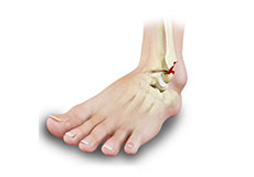 stress fracture in foot